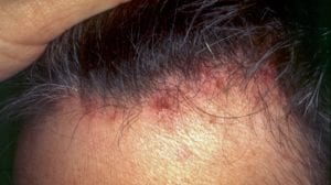 Common scalp problems | Hairdo Hairstyle