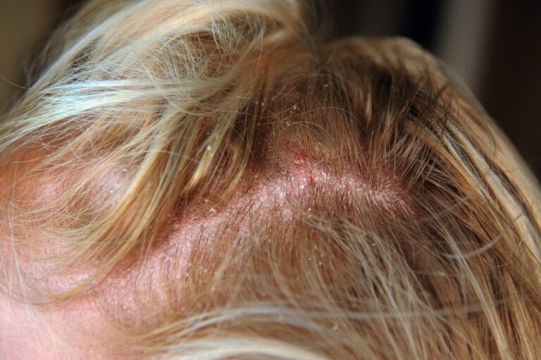 how-to-prevent-treat-scabs-on-the-scalp-after-bleaching-hair